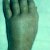Artritis reumatoidea