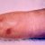 Vasculitis