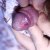 Artritis reactiva. Balanitis circinada