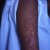 Lupus eritematoso sistémico