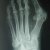 Hallux valgus Rx