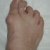 Hallux rigidus Rx
