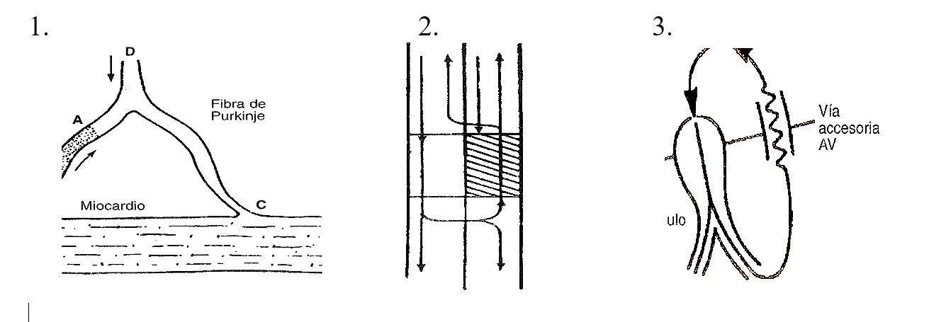 arritmia01