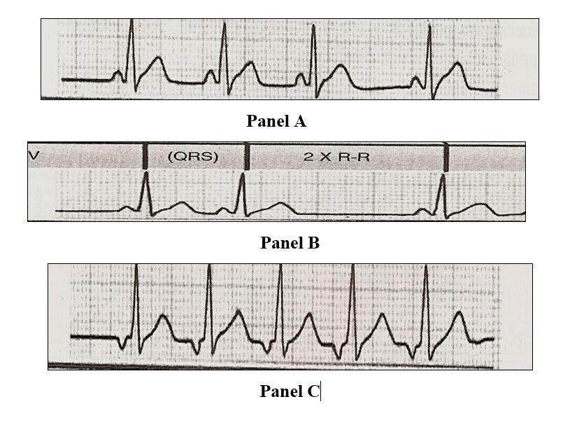 arrhythmia03