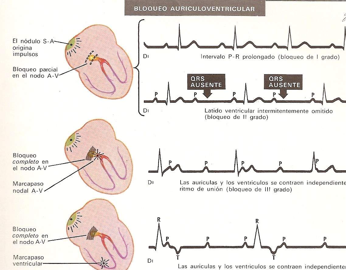 arrhythmia04