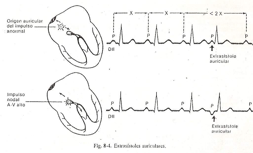 arrhythmia05