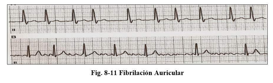 arritmia 09