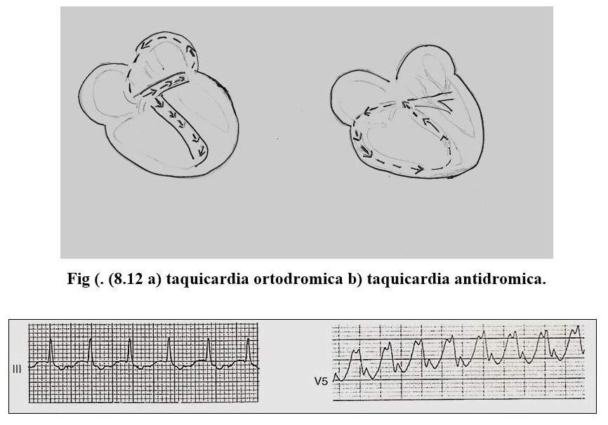 arritmia 11