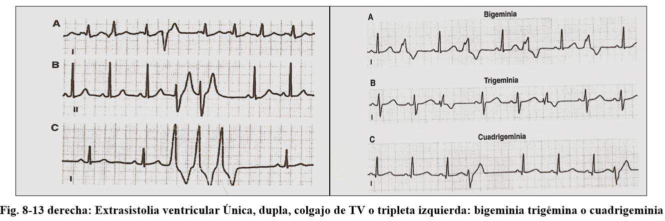 arritmia12