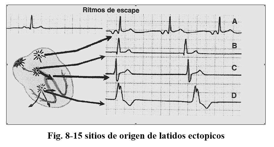 arritmia14