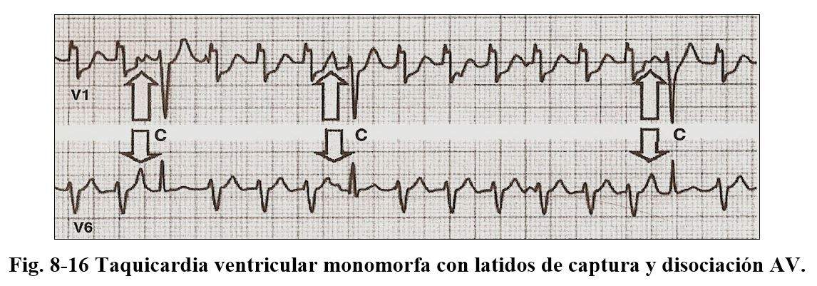 arritmia 15