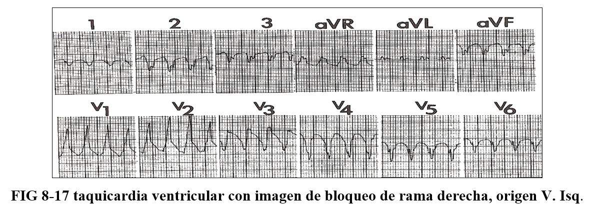 arrhythmia16