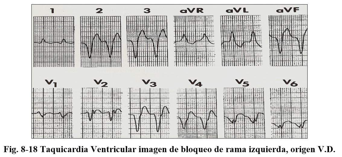 arritmia17