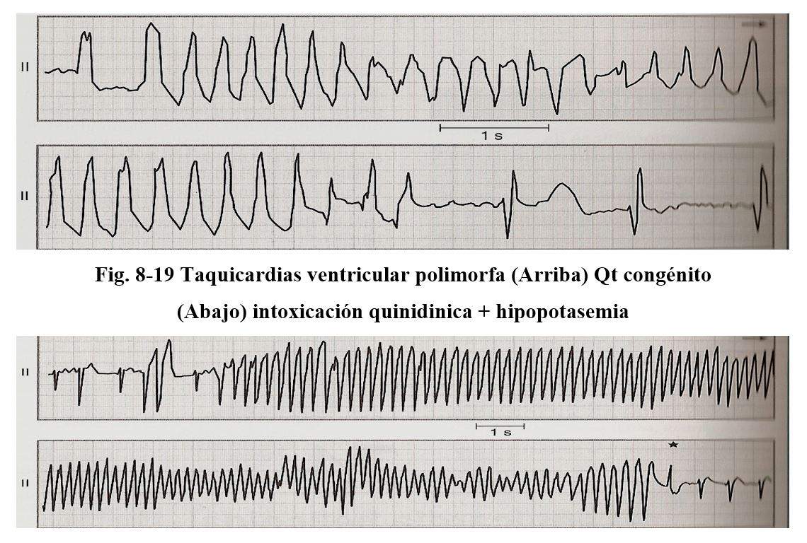 arrhythmia18