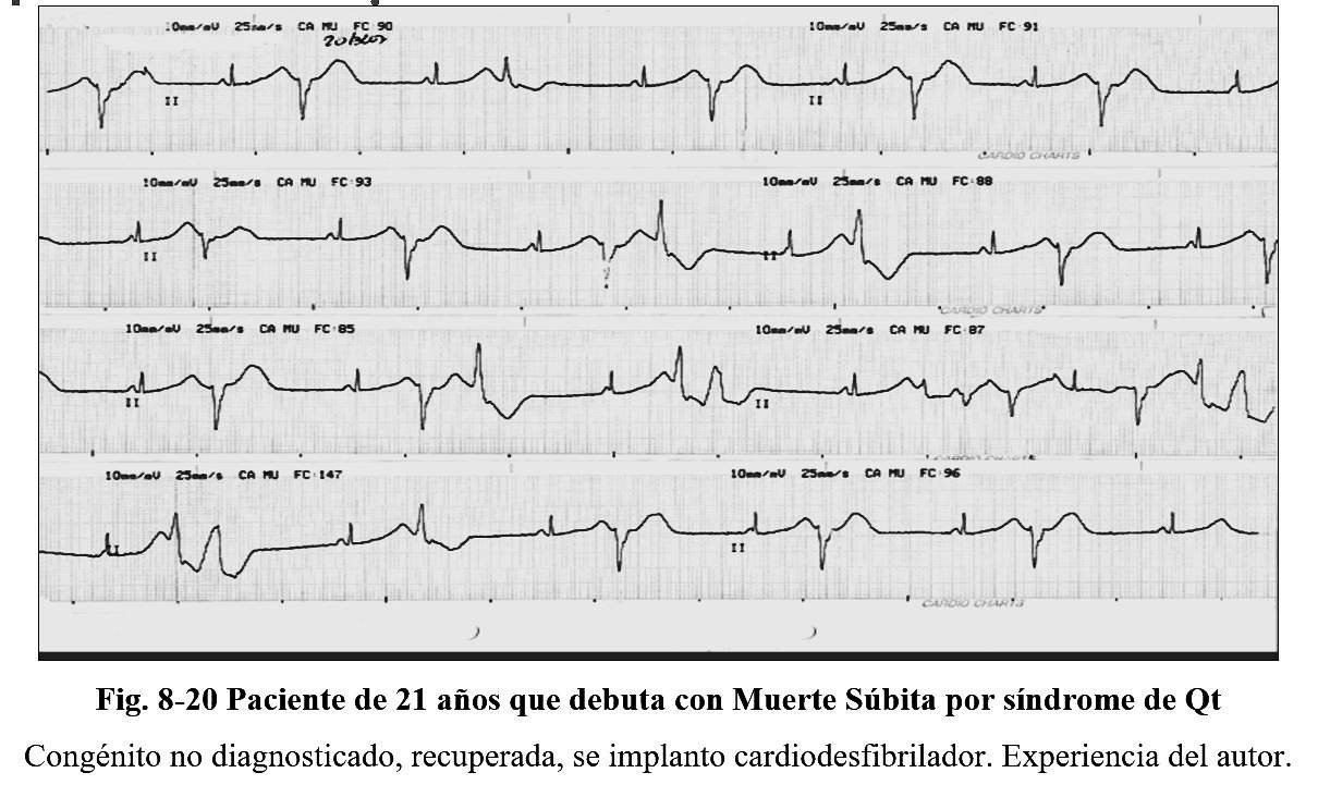 arrhythmia19