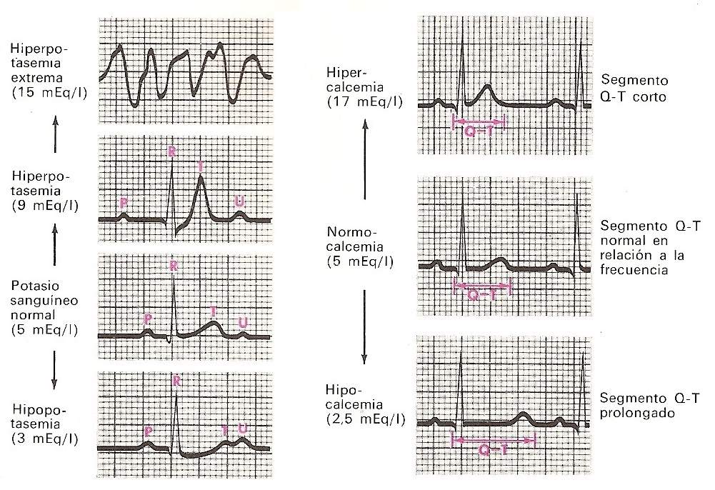 arrhythmia22