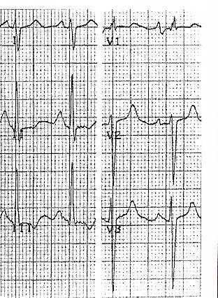 ecg15