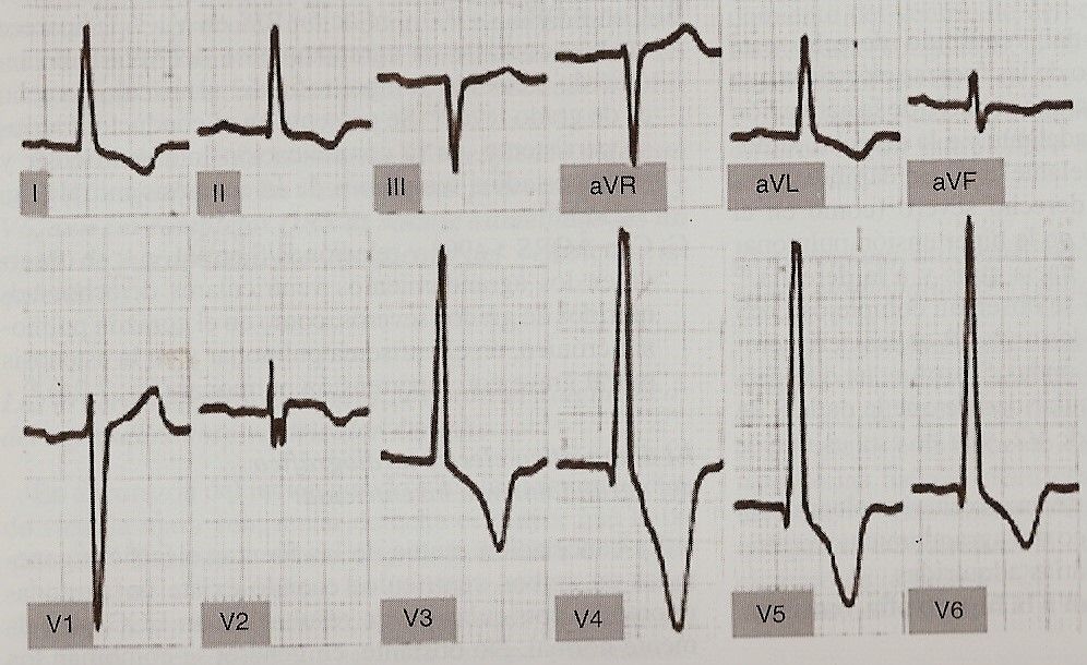 ecg16