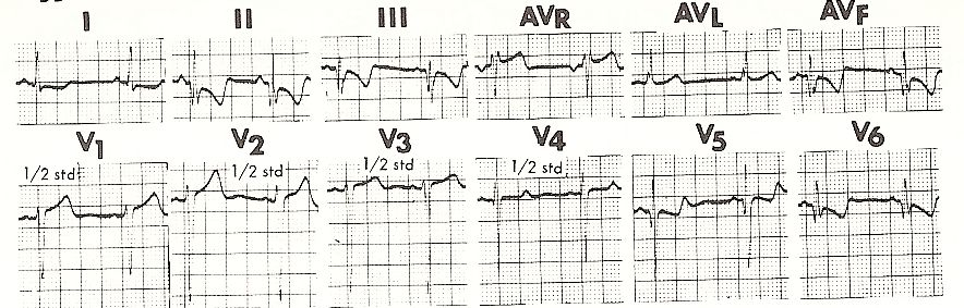 ecg17