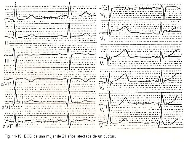 ecg19