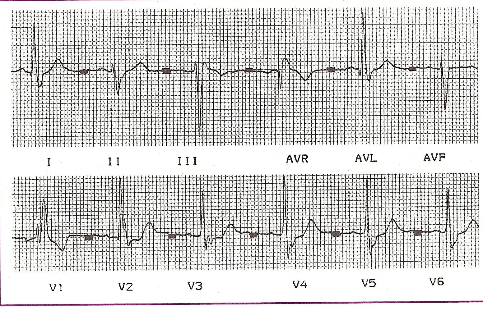 ecg23