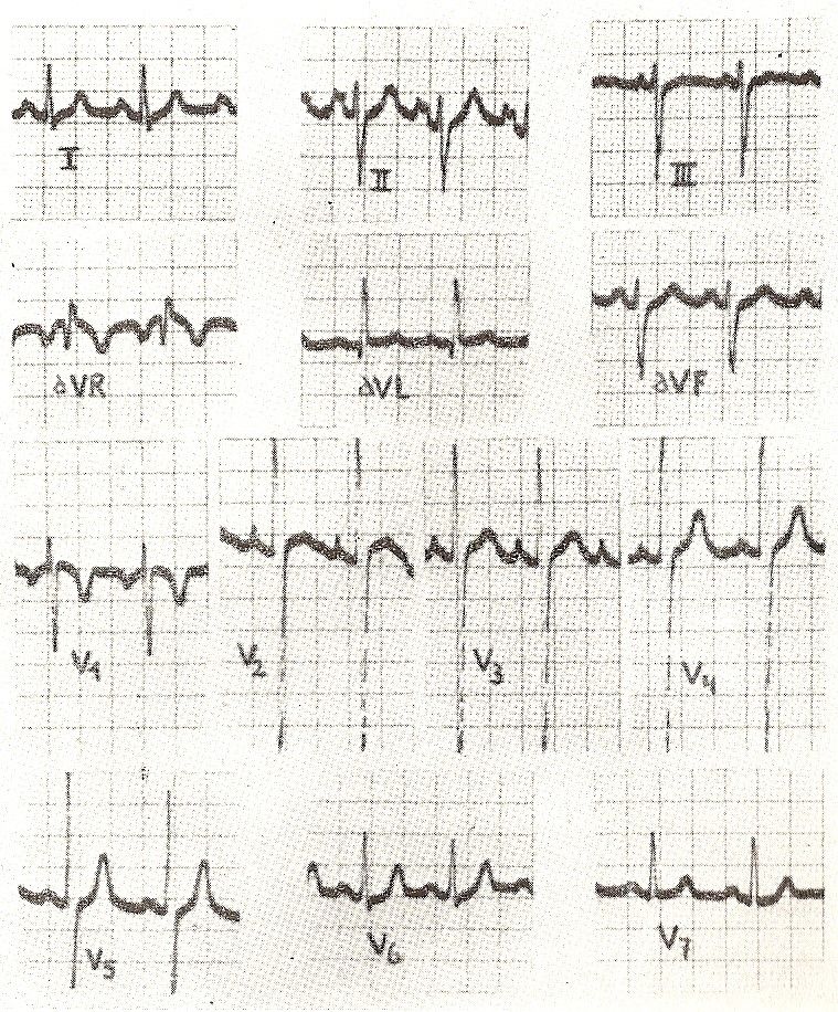 ecg26