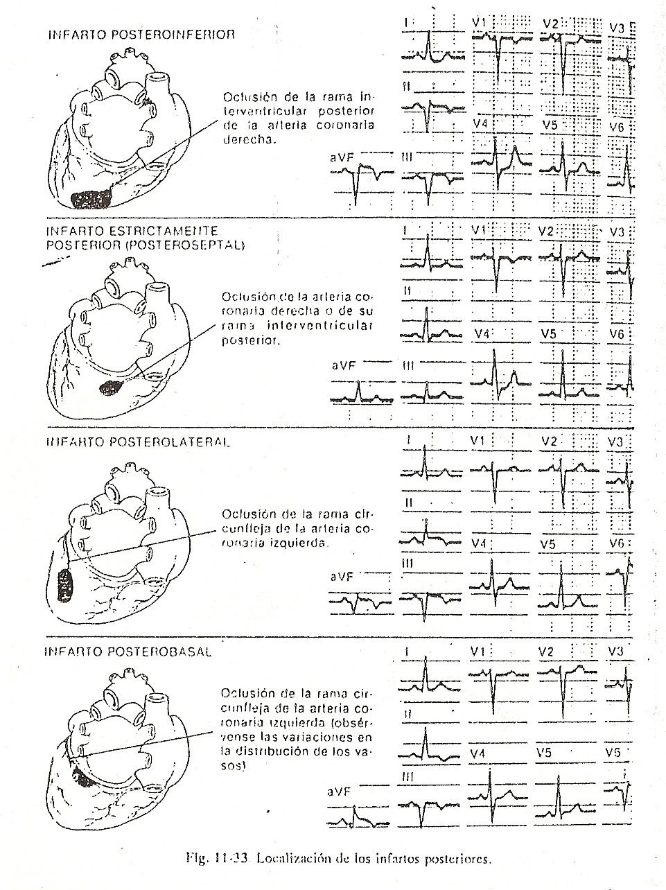 ecg32