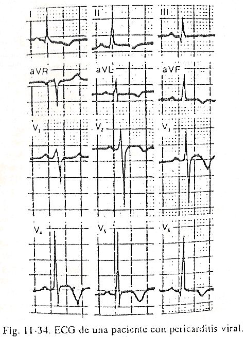 ecg33