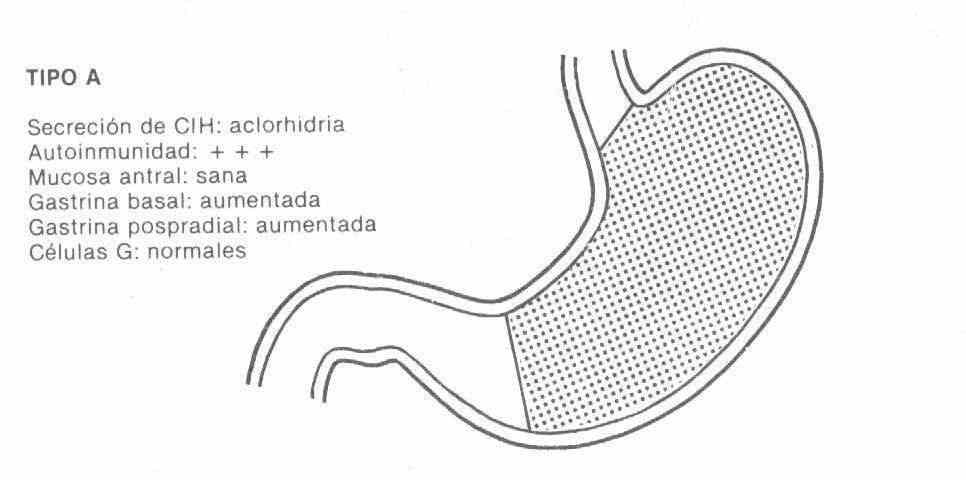 gastrite 03