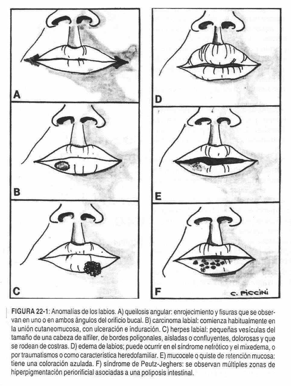 Colección de pseudovisemas. Primera a la izquierda se muestra boca