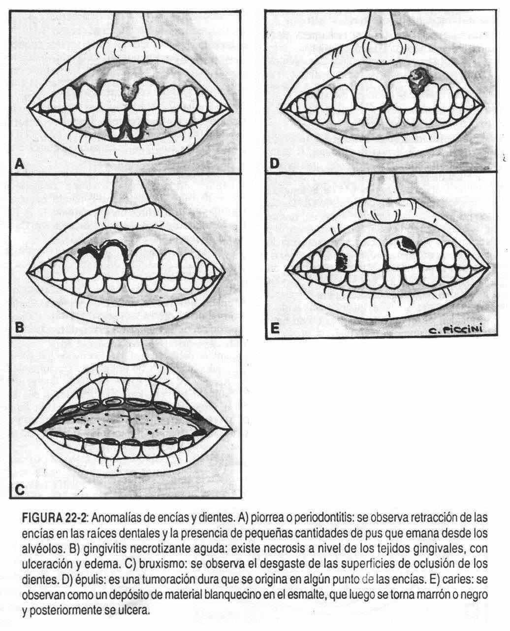 Colección de pseudovisemas. Primera a la izquierda se muestra boca