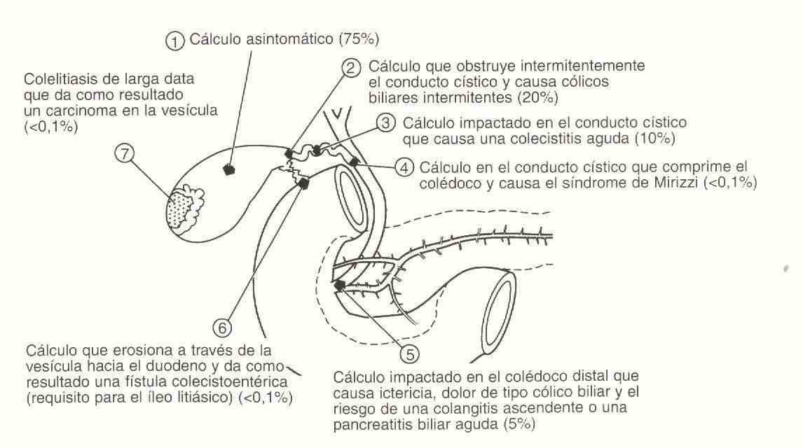 litiasisbiliar