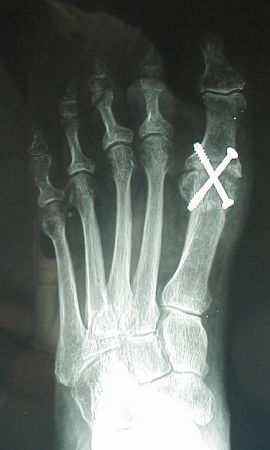 Reparación quirúrgica de Hallux Valgus