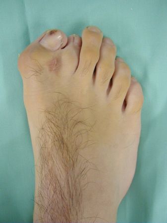 Hallux Valgus