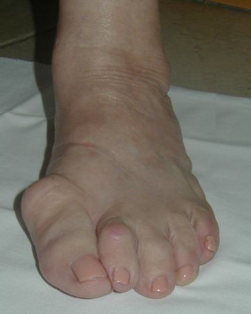 Hallux Valgus