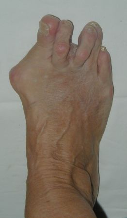 Hallux Valgus