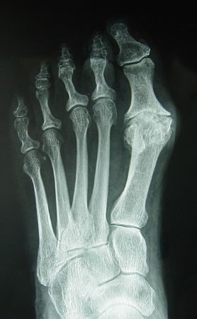 Reparación quirúrgica de Hallux Valgus