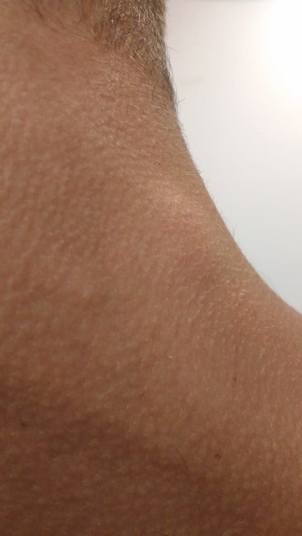 adenopatiacervical