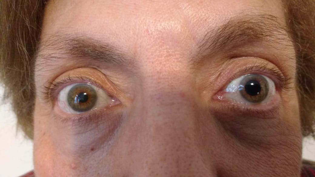 anisocoria02