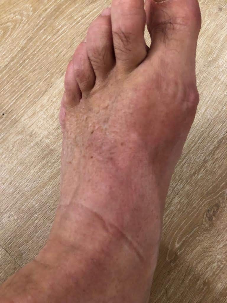 Bursitis