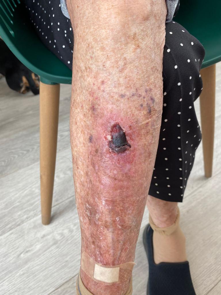 celulitis04