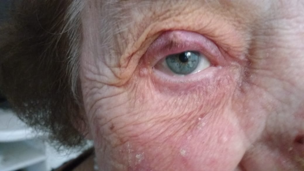 chalazion02