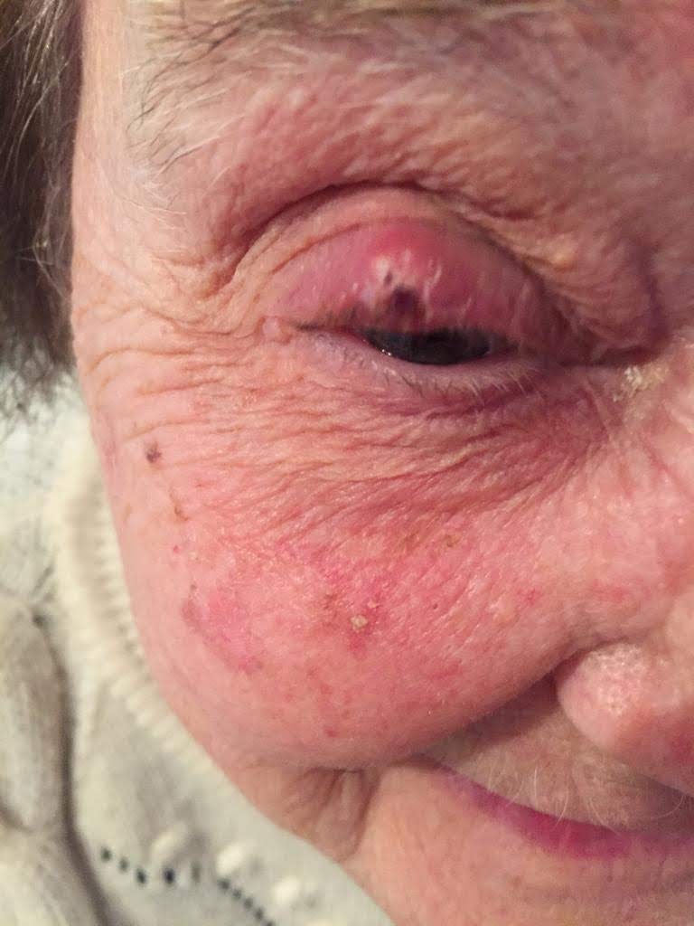 chalazion03