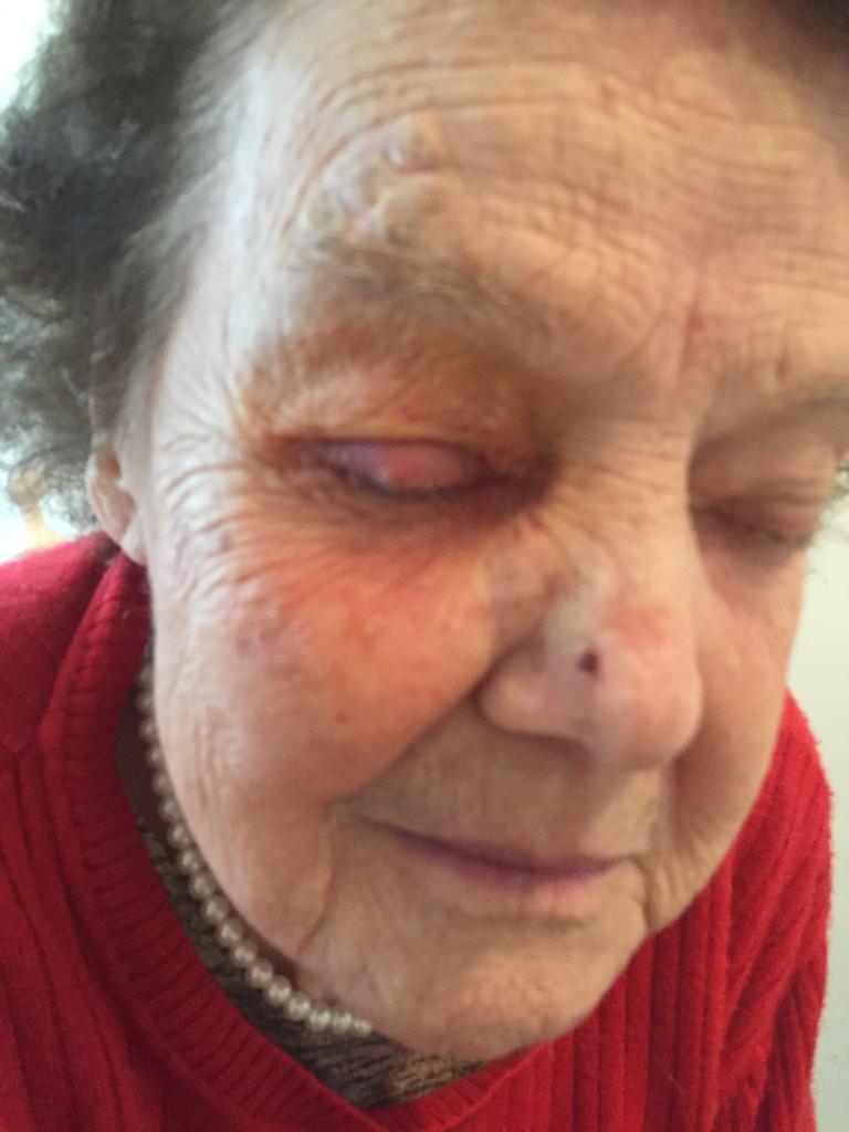 chalazion04