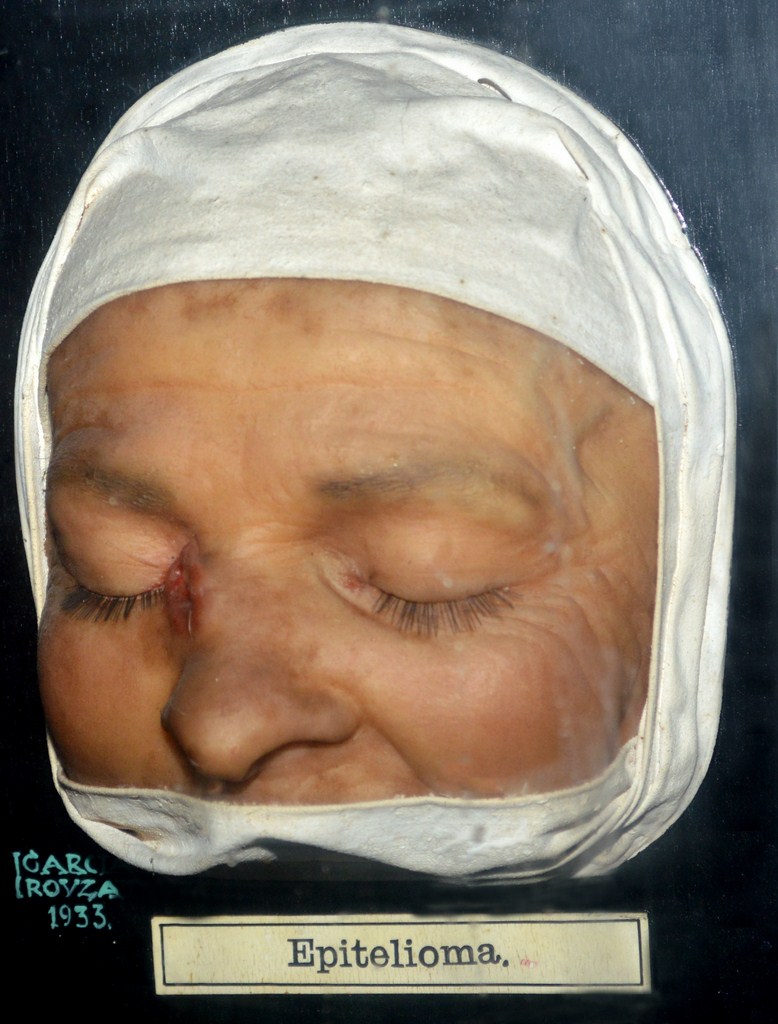 epitelioma3