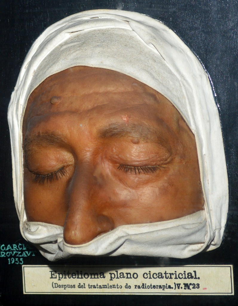epitelioma_plano_cicatricial