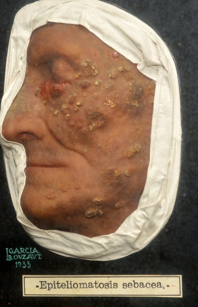 epiteliomatosis_sebacea