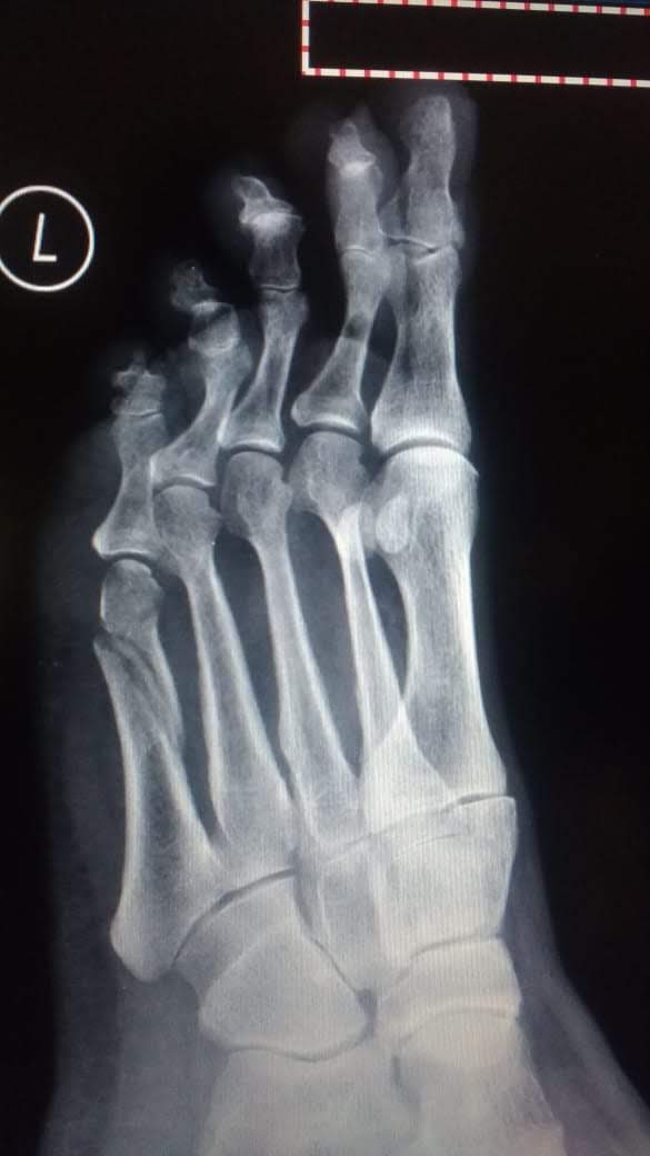 Fractura del 5to metatarsiano