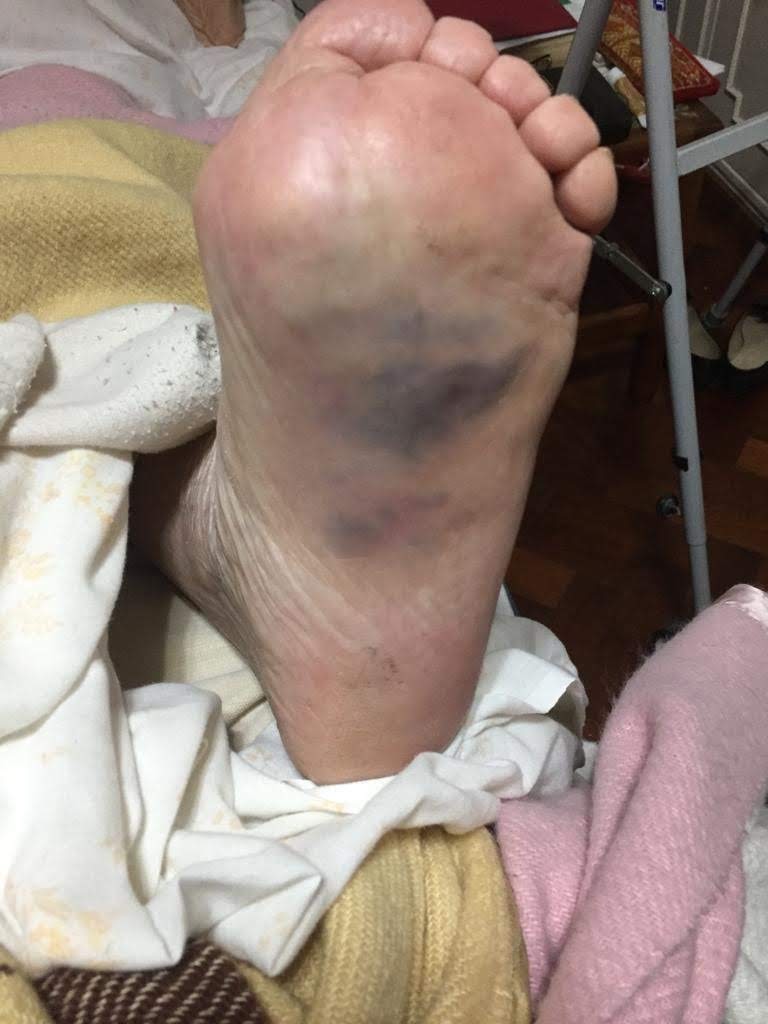 Fractura metatarsiana