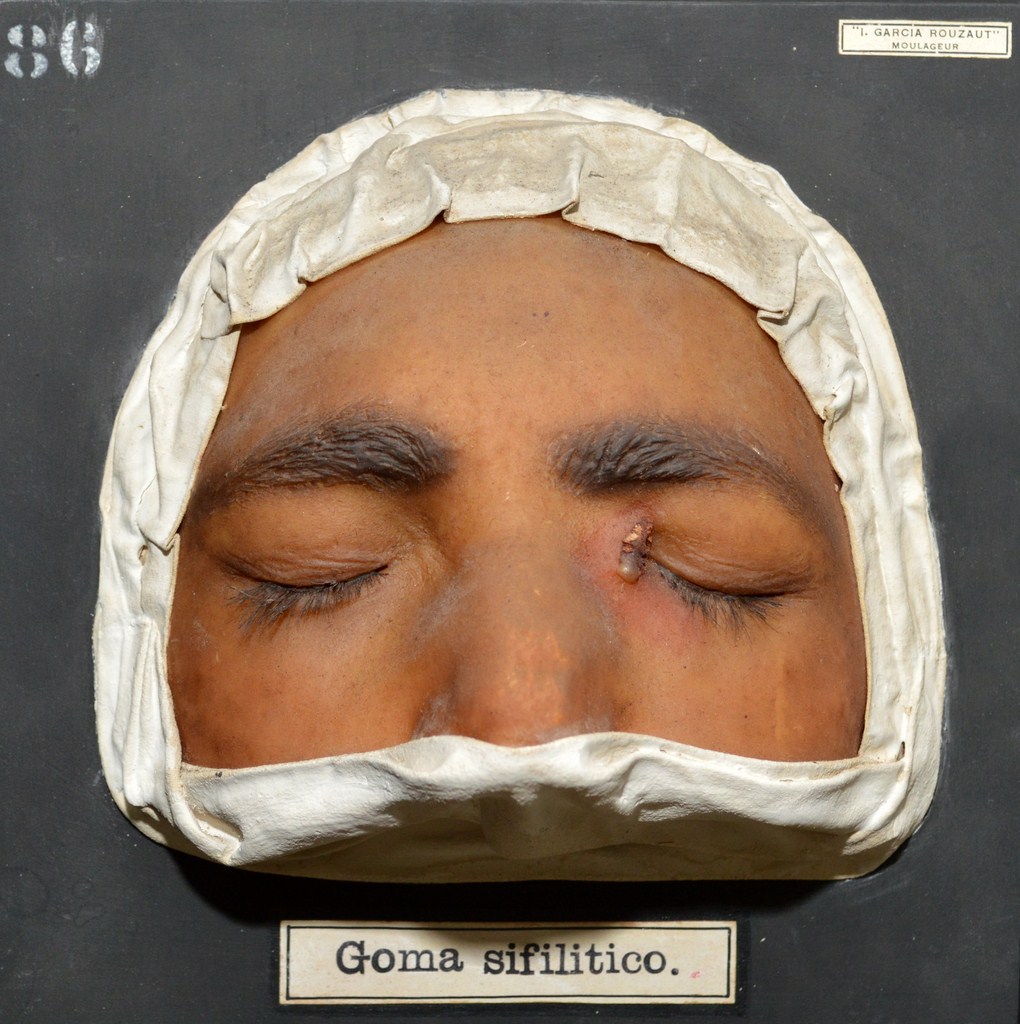 goma_sifilitico
